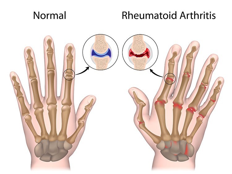 Rheumatoid Arthritis Pain Relief In Bellmore , NY - Bellmore Acupuncture Clinic
